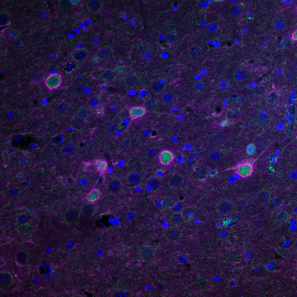 CHEMOGENETICS RESCUES THE HEALTH OF PERINEURONAL NETS IN PINK THAT SURROUNDS NEURONS IN GREEN IN THE ALS MOUSE BRAIN.